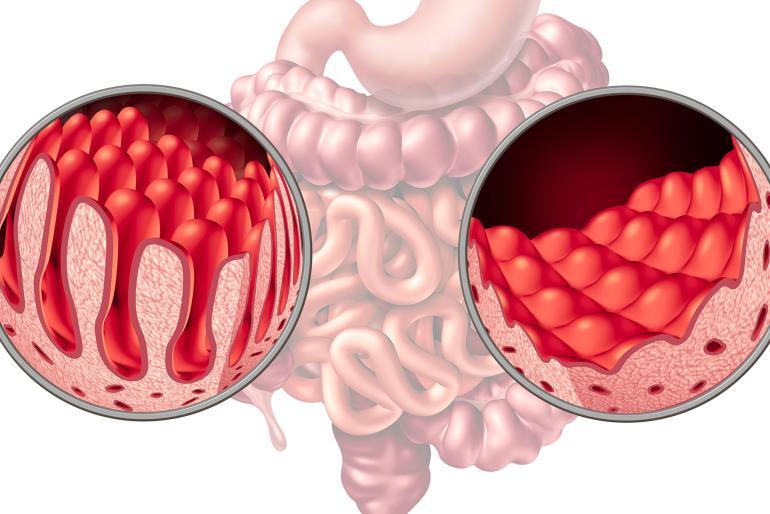 cos e la celiachia e che cosa vuol dire essere celiaco gran chef evolution